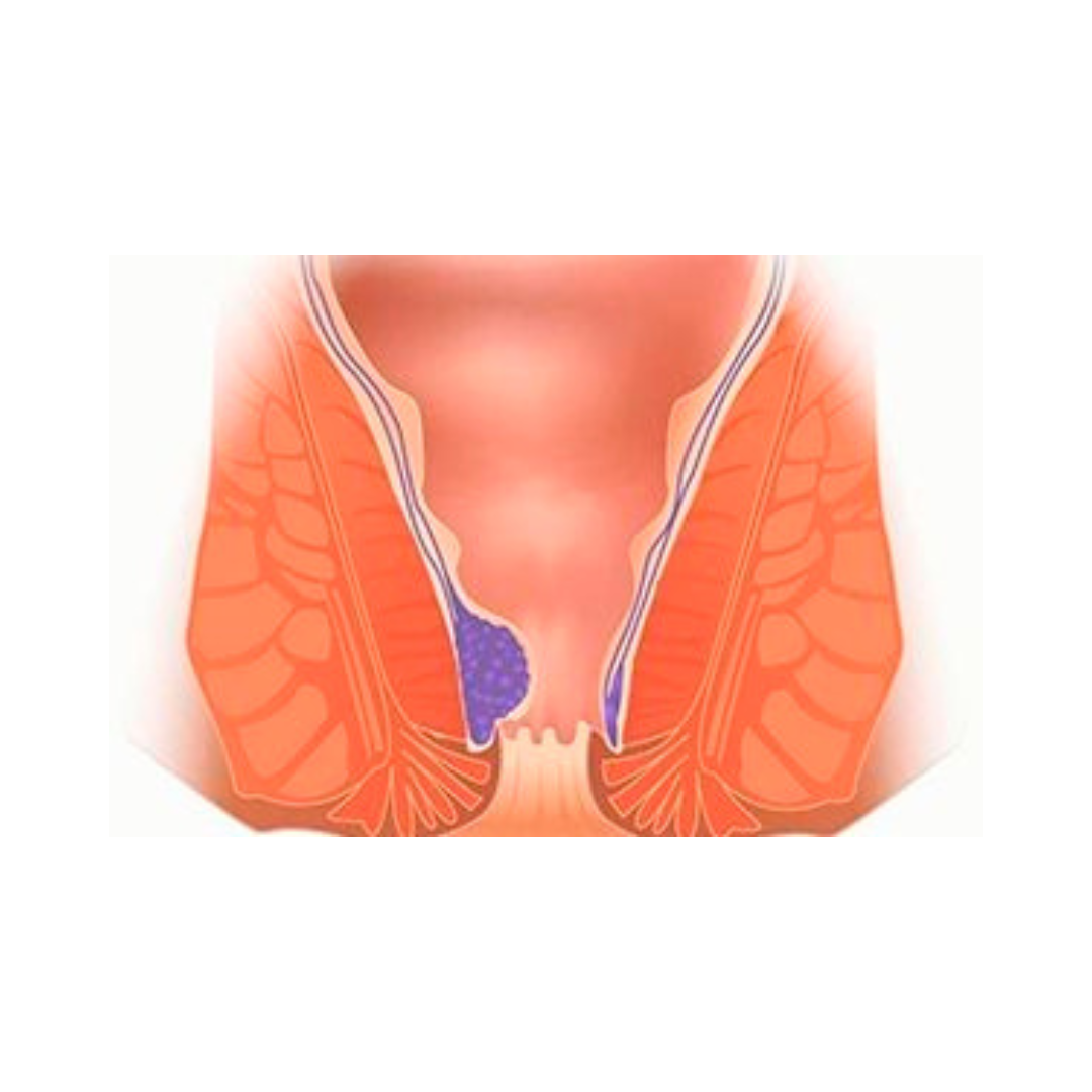 Fistula in ano/Pruritus ani