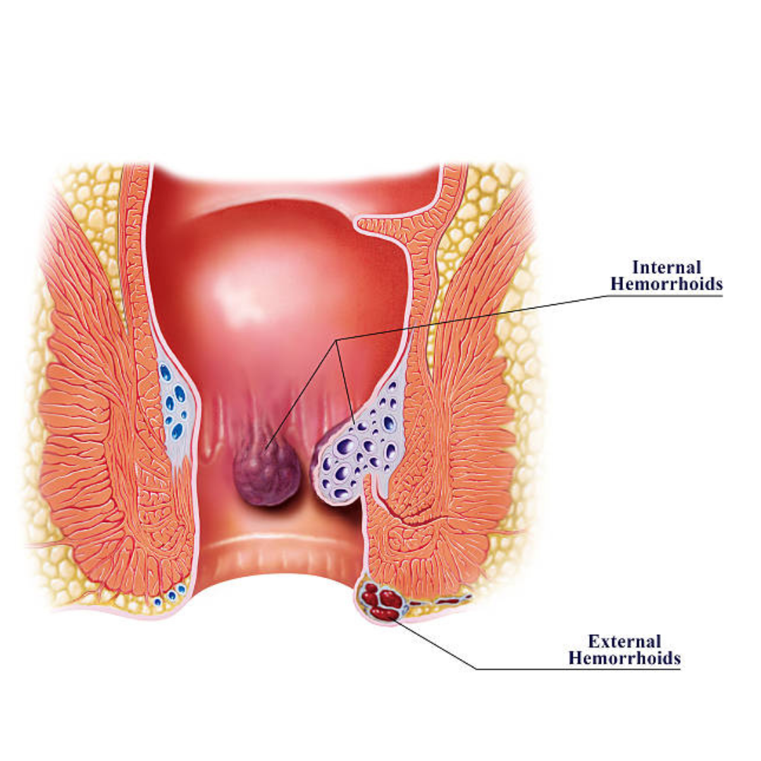 Hemorrhoids