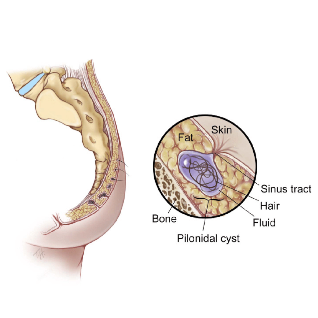 Pilonidal Sinus