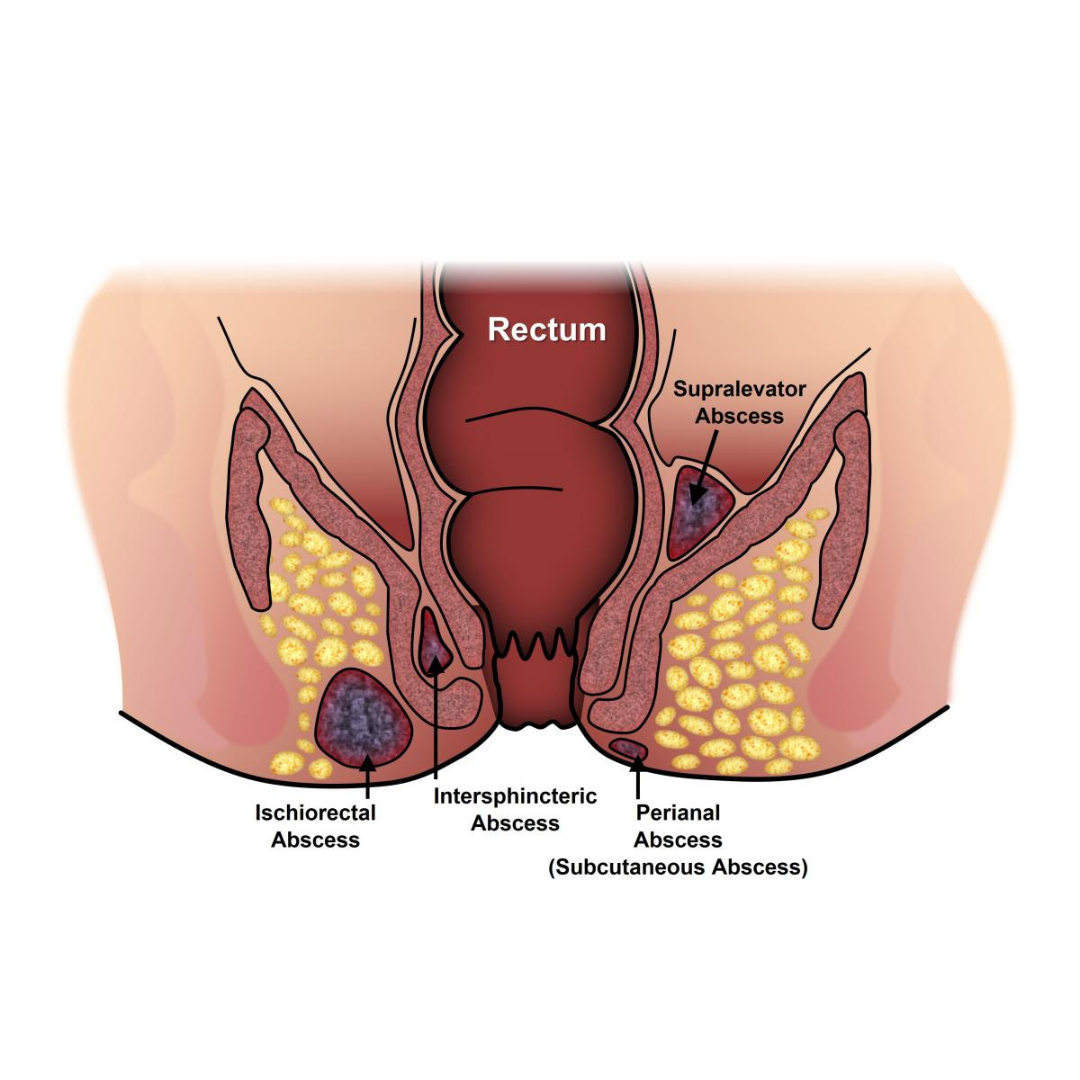 Perianal Abcess(