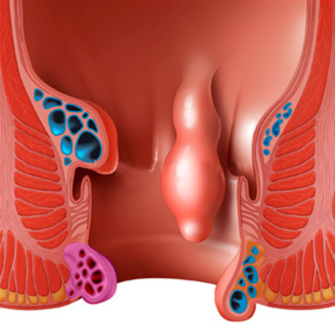 Rectal polyp