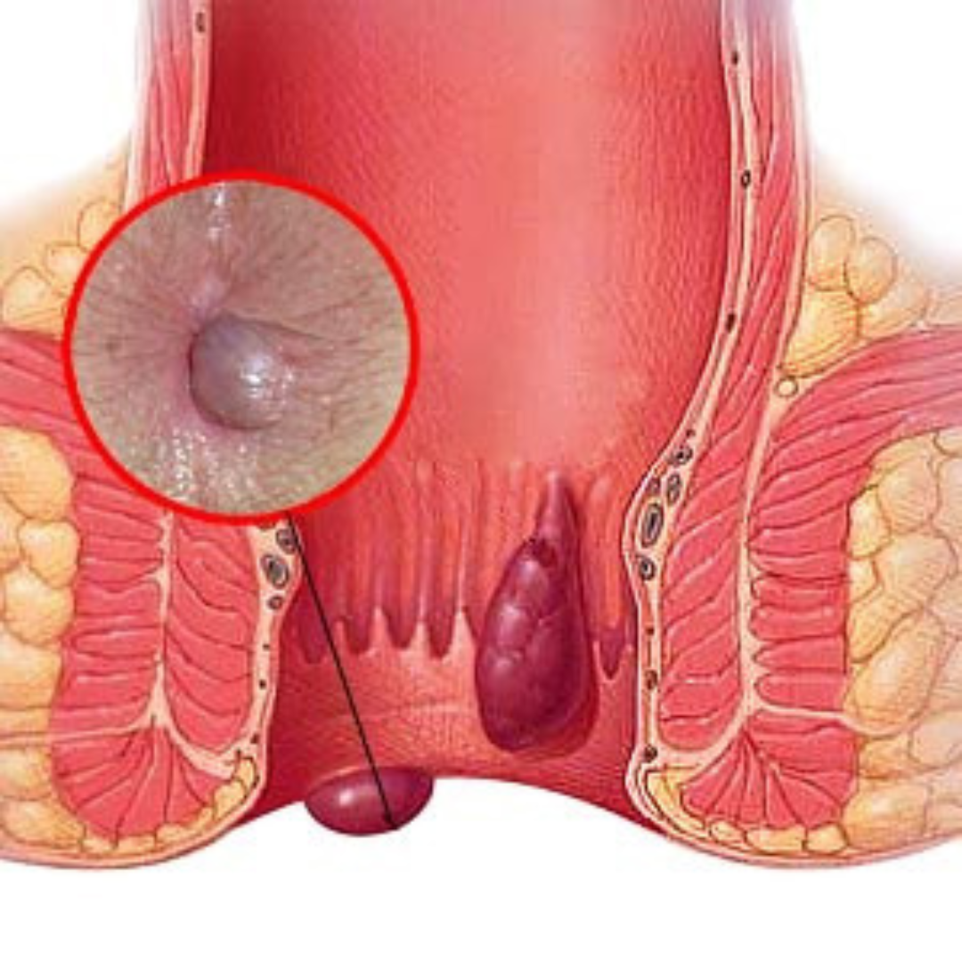 Anal hematoma
